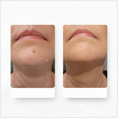 Velunacare MicroClear™ Microneedle Patch