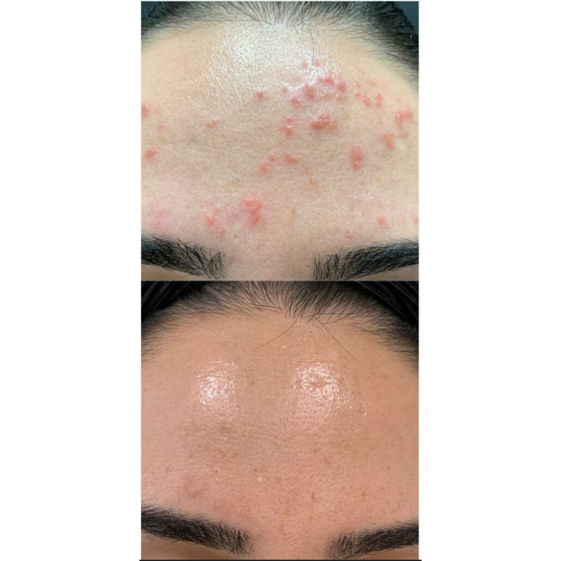 Velunacare MicroClear™ Microneedle Patch